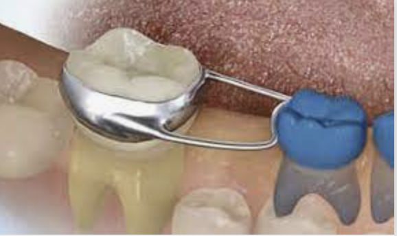 Restorative Dental Care