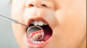 Great Food Options for Children to Eat After a Frenectomy
