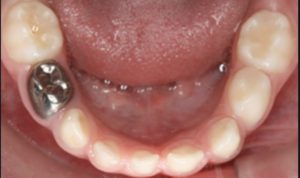 Restorative Dental Care